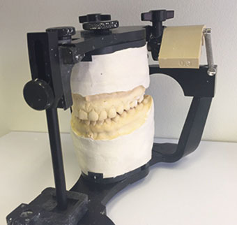 Mounted Casts on a semi-adjustable articulator