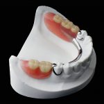 Removable partial chrome cobalt denture