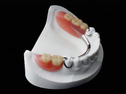 Removable partial chrome cobalt denture