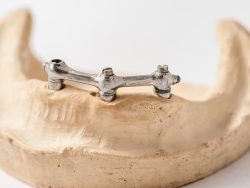 Lower implant over-denture bar
