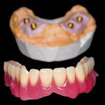 Implant-retained over-denture