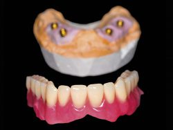 Implant-retained over-denture
