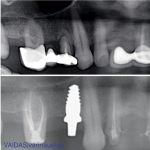 Before and after X-rays showing zirconia implant in situ