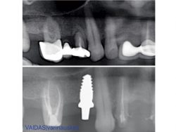 Before and after X-rays showing zirconia implant in situ