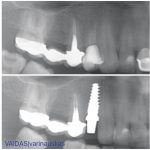 Single zirconia implant placement