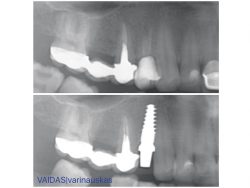 Single zirconia implant placement