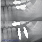 Before and after X-rays showing zirconia implants in situ