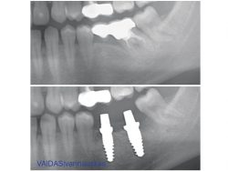 Before and after X-rays showing zirconia implants in situ