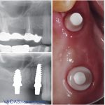 Before and after X-rays and intra-oral photograph