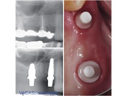 Before and after X-rays and intra-oral photograph
