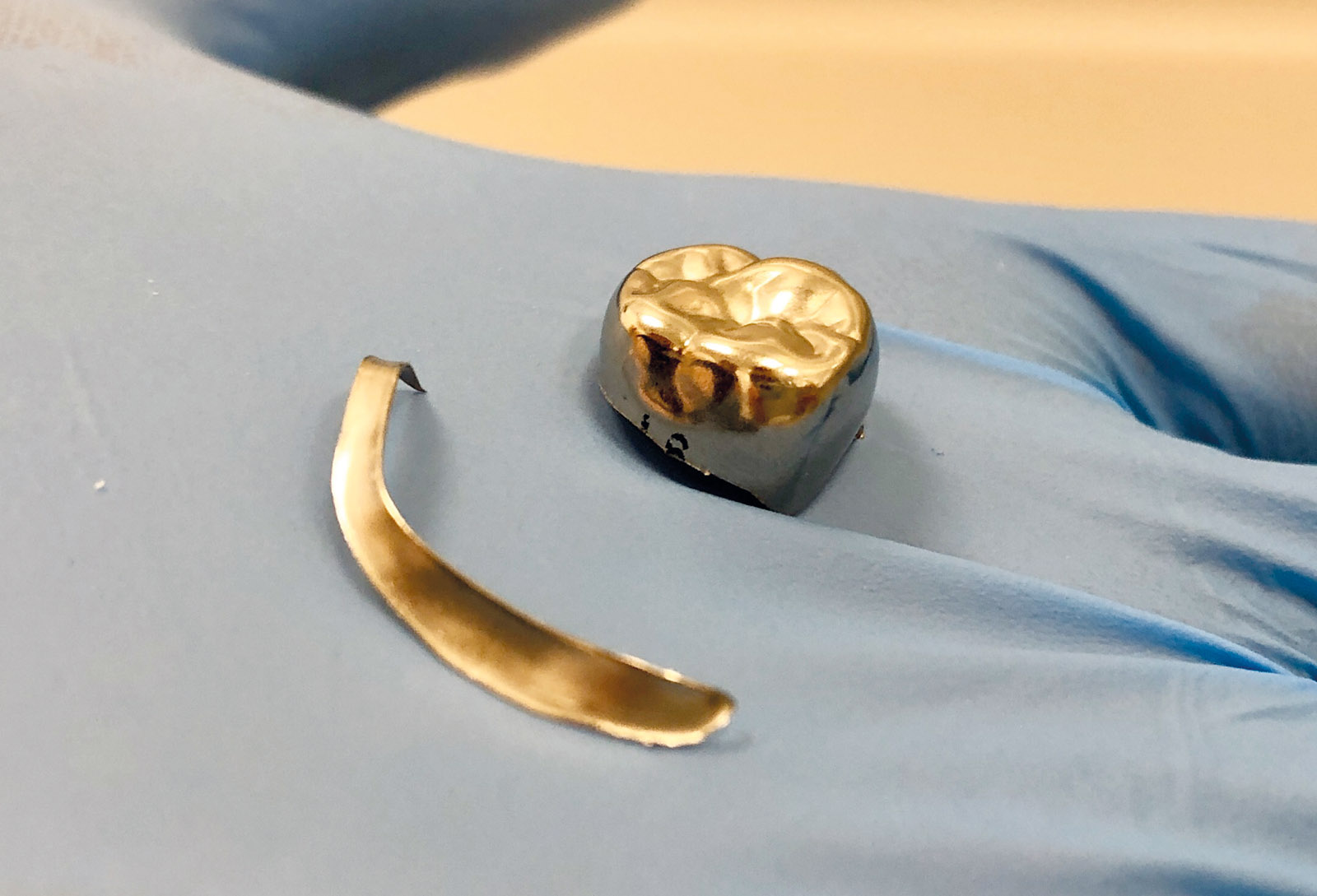 Use of stainless steel crowns in the permanent dentition of paediatric dental patients A guide