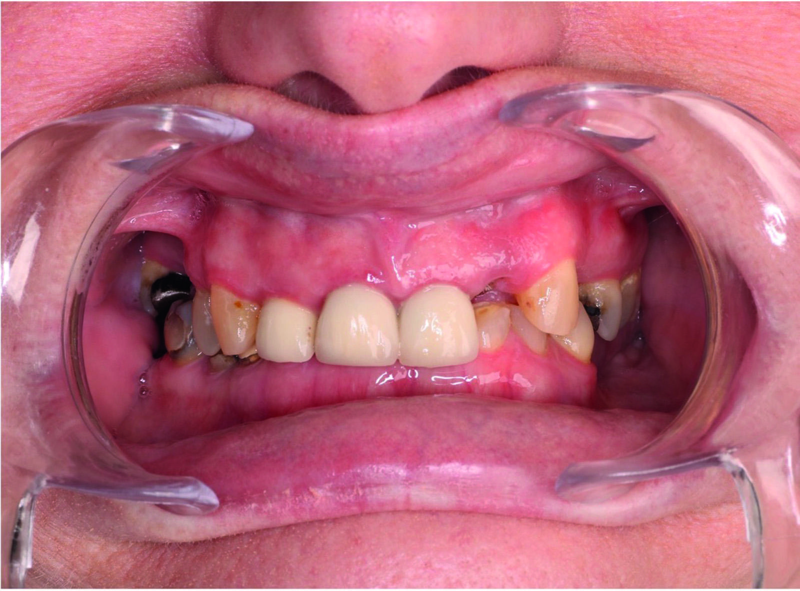 Close up of patients teeth and gums