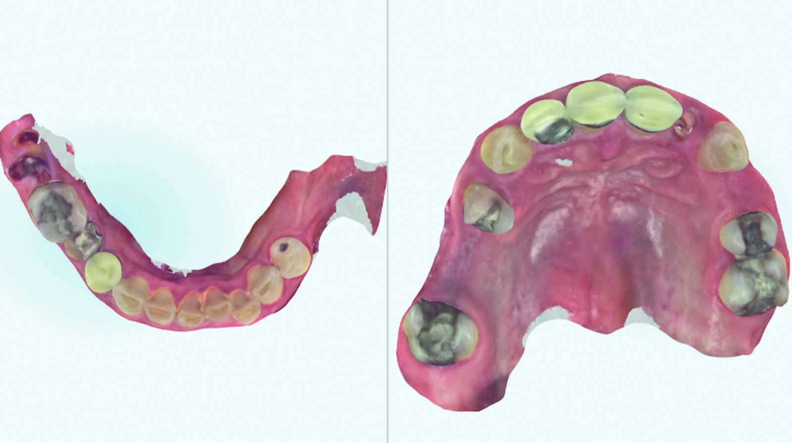 Accurate 3D intra-oral scans