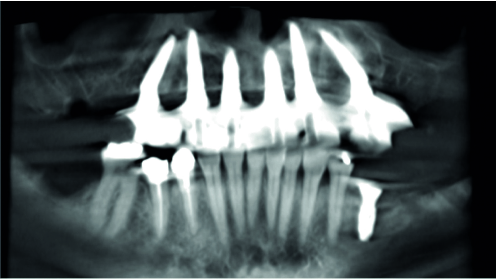 Upper arch rehabilitation using dental implants Ireland's Dental Magazine